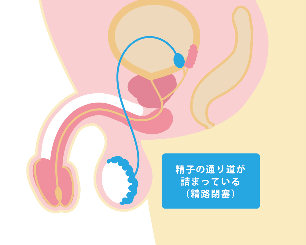 精液量が多いけど不妊の原因あり？見分け方や治療法を解説 | 男性不妊治療は銀座リプロ外科