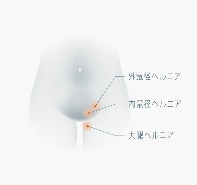 消化器外科 おなかのヘルニアセンター｜診療科・部門のご案内｜近畿大学奈良病院