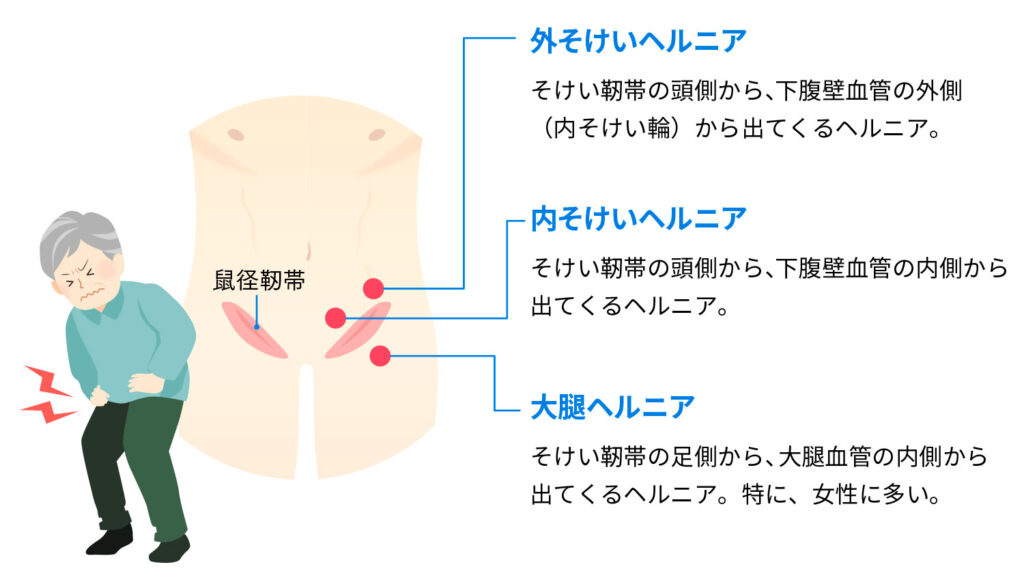 奈良県の鼠径ヘルニア(そけいヘルニア)/脱腸の専門治療が可能な病院 24件 【病院なび】