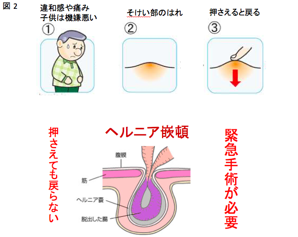 千葉県で鼠径ヘルニア・脱腸を治療｜Kenクリニック