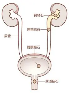 ５分でわかる尿路結石｜激痛が起きる前に検査|まえばる泌尿器科