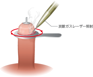 男性器 包茎手術 | 診療内容