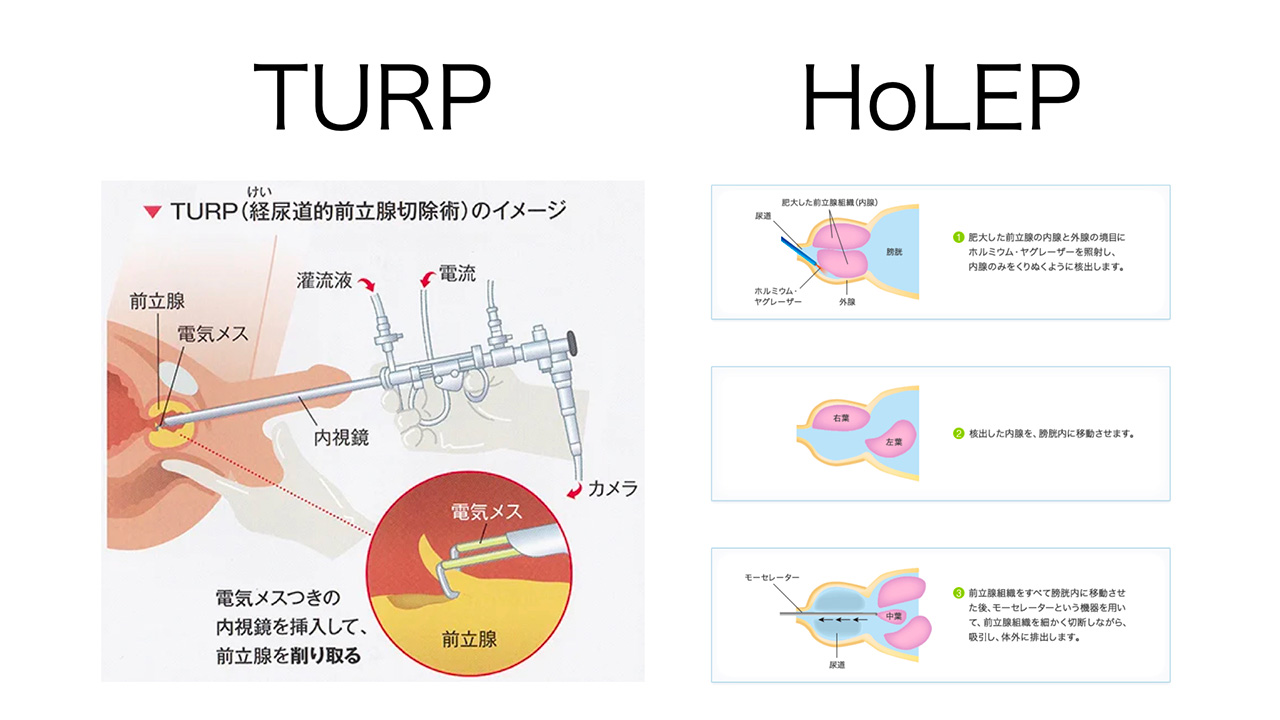 新都心クリニック【公式】新宿 泌尿器科 TURP(経尿道的前立腺全切除術）