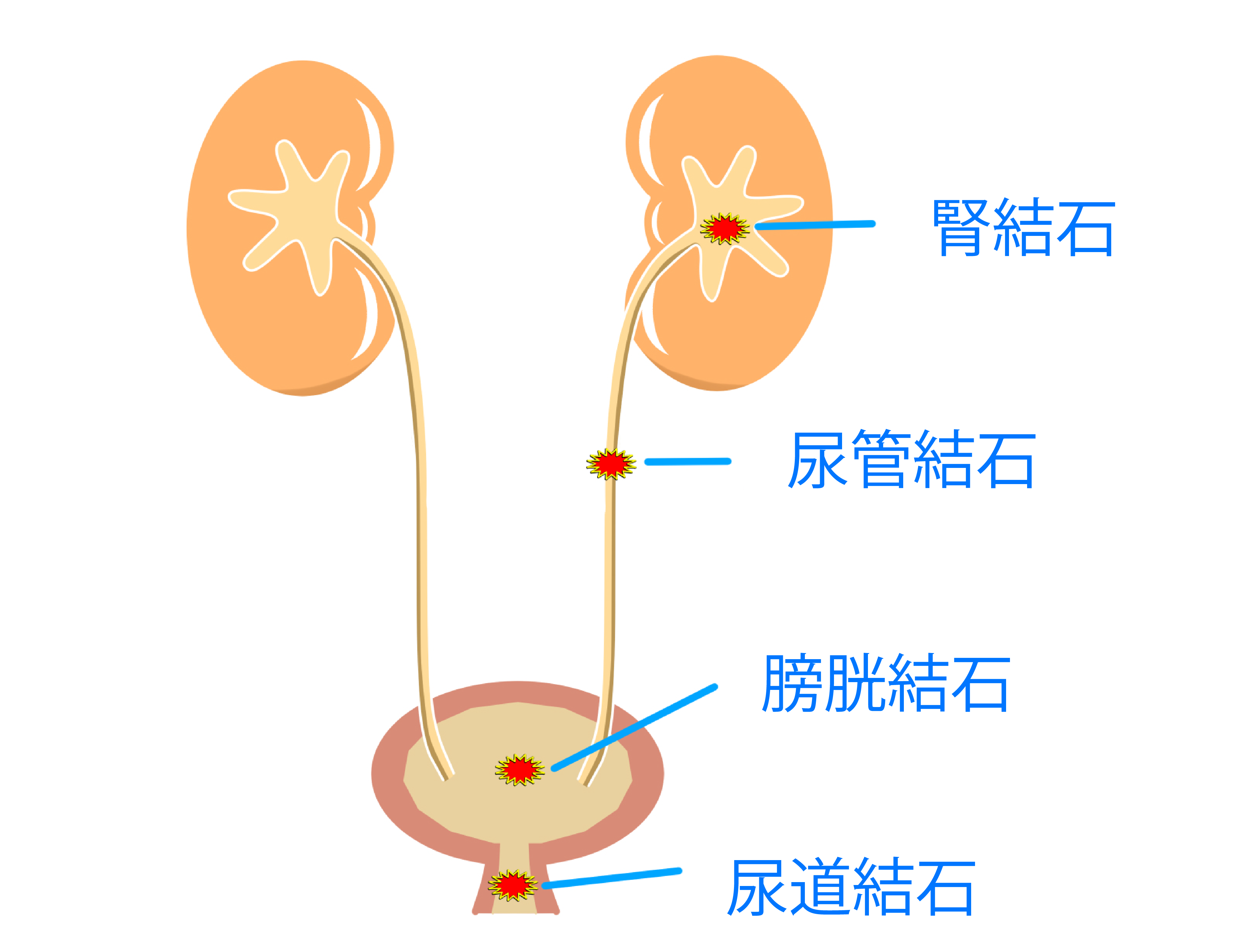 尿路結石治療への取り組み