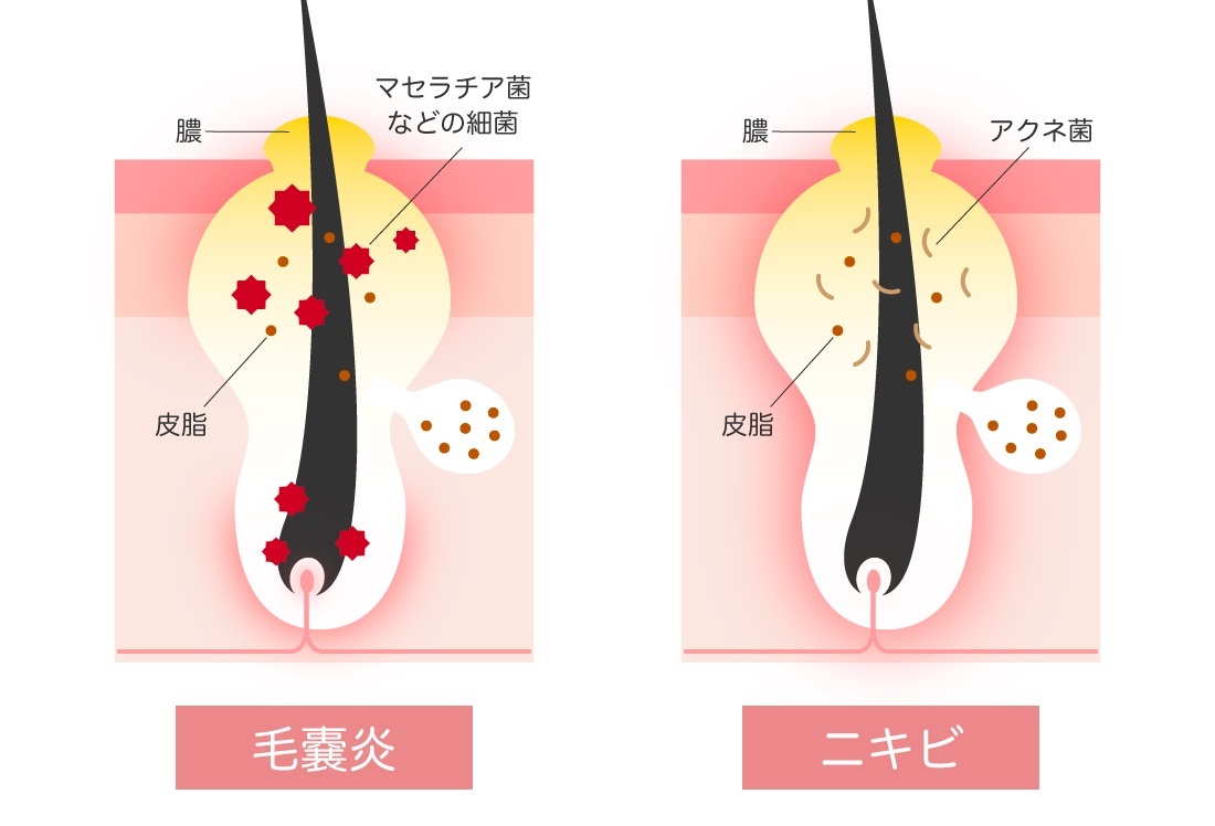 マダニに刺されてしまったら | 鵬図商事株式会社