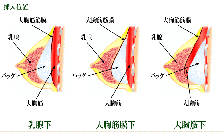 離れ乳（離れたバスト）の原因と対策は？セルフケアで行える改善方法はある？ | 豊胸・豊胸手術なら城本クリニック