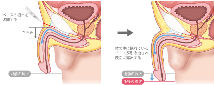 ７０代でも長茎手術！「ダランと垂れたペニスになる！」 | ネオ形成外科