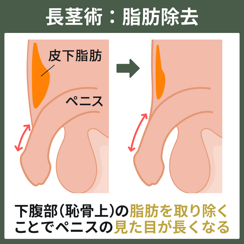 ペニスのサイズが小さくなることはあり得るのか？その原因と対策