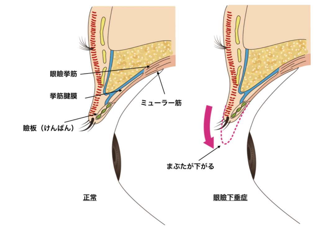 スカーレス傷跡修正アートメイク ストレッチマーク(ヒップ) |