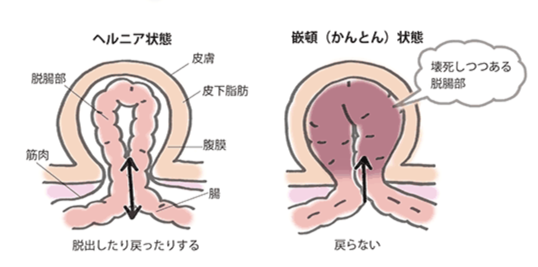 鼠径ヘルニアとは - 東京の鼠径ヘルニア日帰り手術専門│調布駅前そけいヘルニアクリニック【公式】