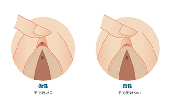 女性の包茎とは？クリトリス包茎における一般的な悩みと対処法 - アトムクリニック