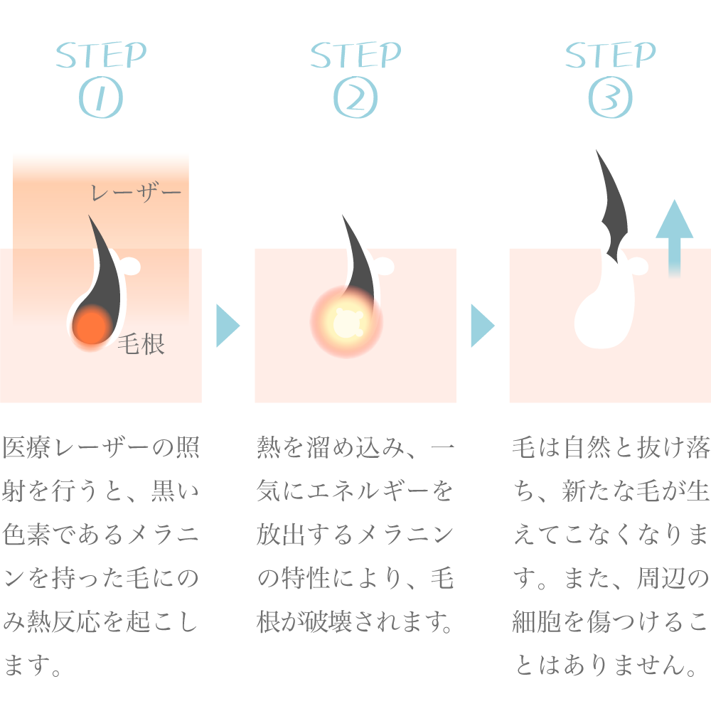 ヒゲ脱毛直後におきる泥棒ヒゲについて｜【公式】メンズリゼのヒゲ脱毛専門サイト