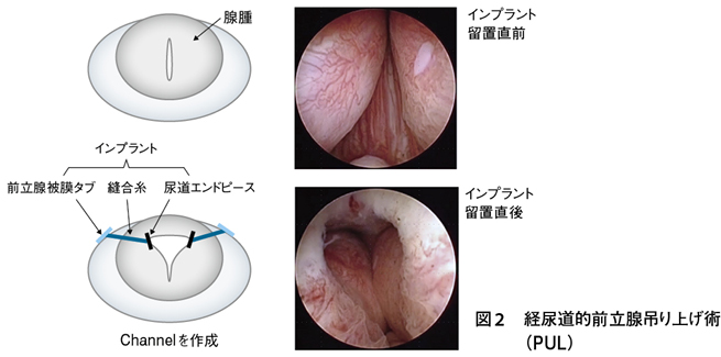 前立腺肥大症の治療で使われる薬とその効果について解説【神楽岡泌尿器科】 - 医療法人神楽岡泌尿器科 |