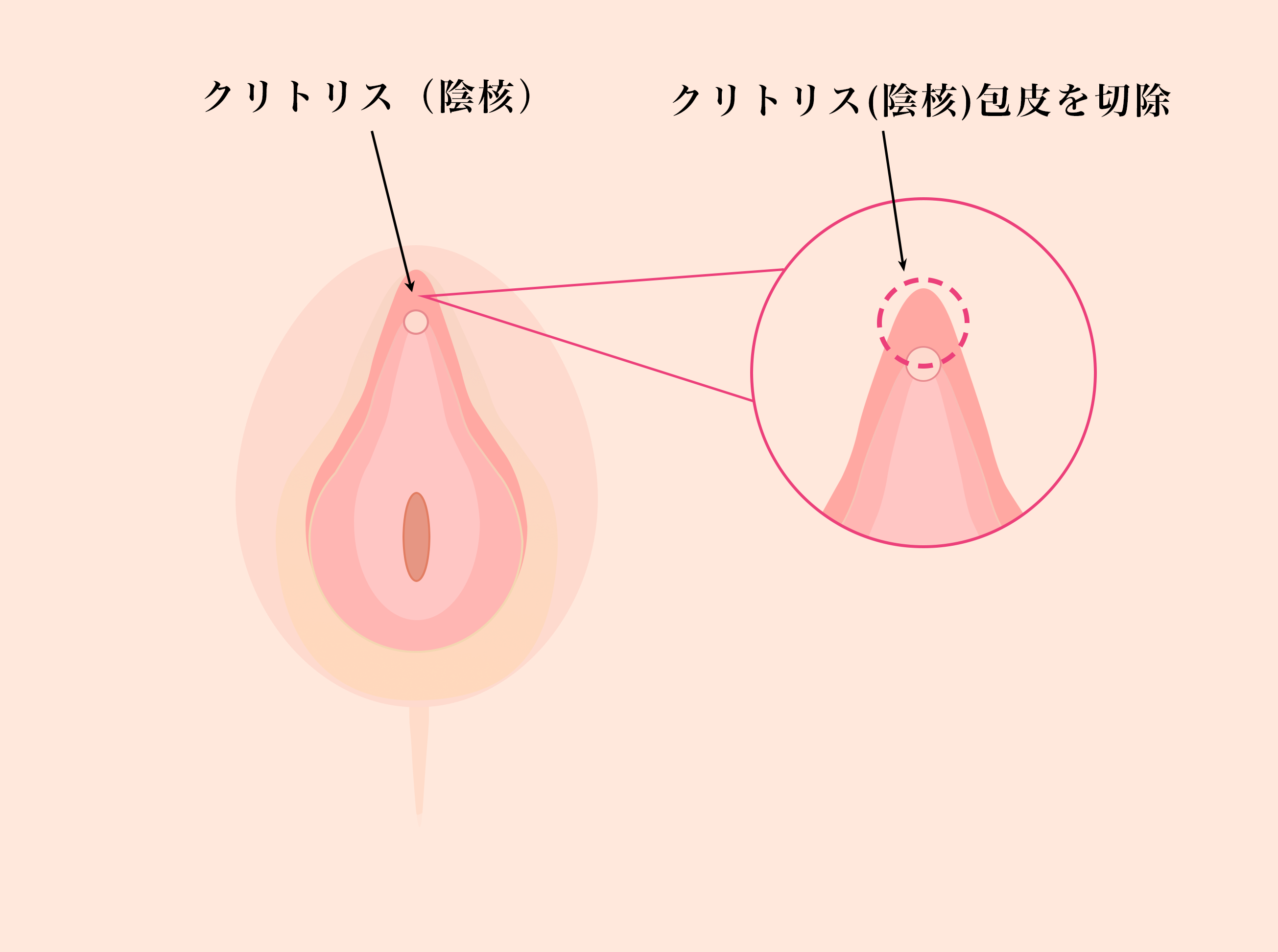 恥垢とは？溜まりやすくなる原因と治療法の解説 | コラム一覧｜ 東京の婦人科形成・小陰唇縮小・女性器形成・包茎手術・膣ヒアルロン酸クリニック