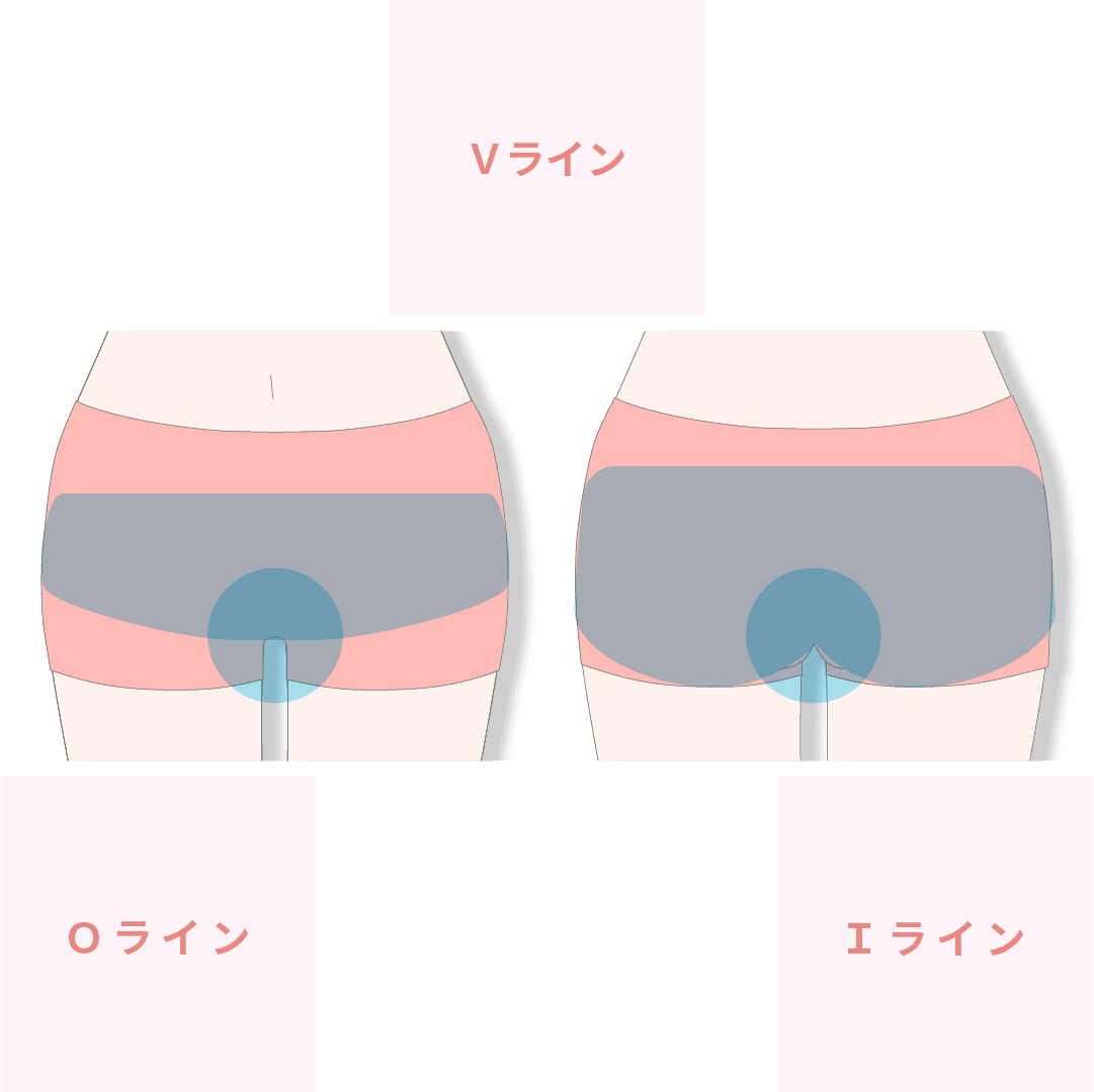 VIO脱毛｜なかにし形成外科クリニック