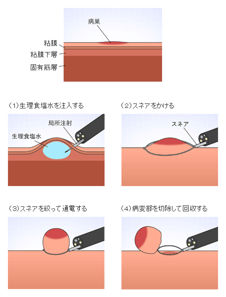 簡易懸濁法について - 独立行政法人国立病院機構 東京医療センター