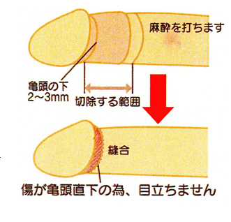 包茎の種類と特徴が知りたい。デメリットはありますか？【専門医が回答！男性の体Q&A③】 | yoi（ヨイ）