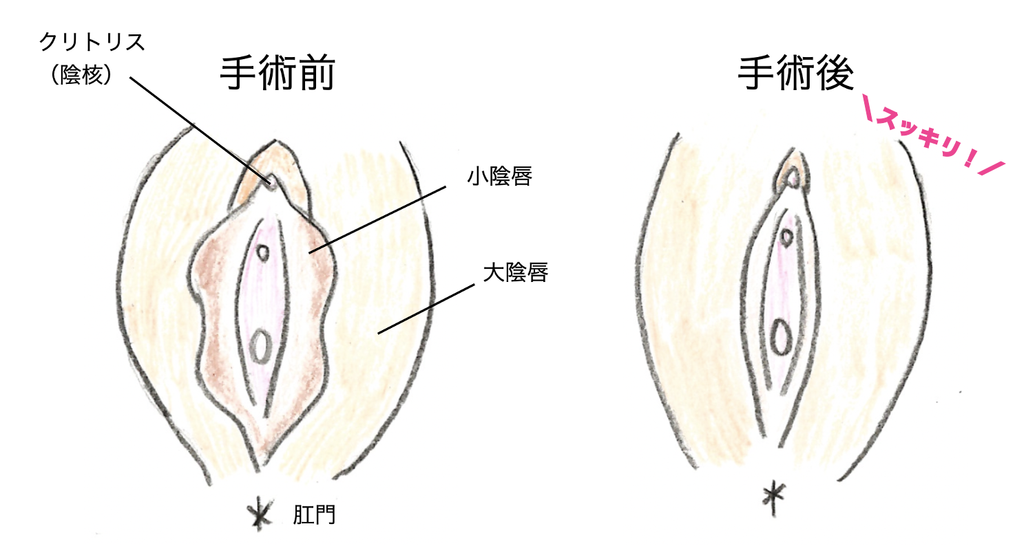 クリトリス包茎 | アールビューティークリニック 銀座・名古屋・大阪｜美容整形・美容外科・美容皮膚科