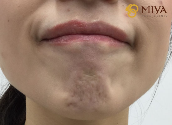 梅干しアゴを撃退する顔ヨガ法