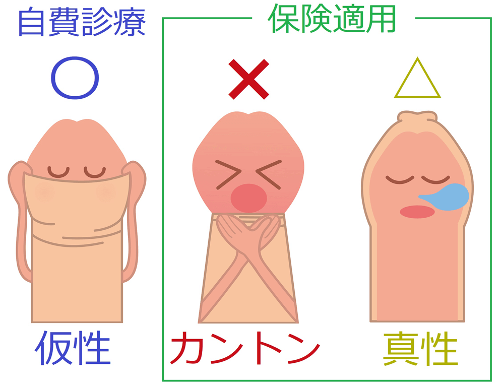 彼氏が包茎！仮性や真性などの種類と臭い - 夜の保健室