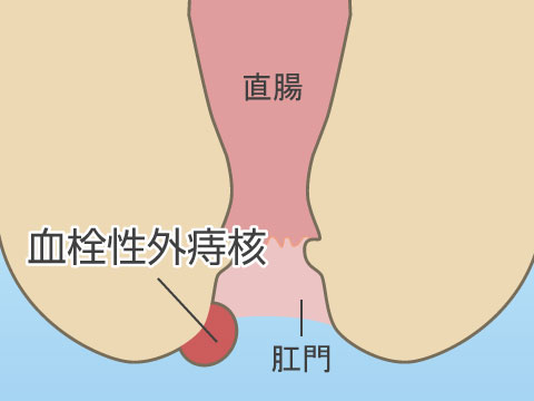 臍炎、尿膜管遺残症の治療について | 医療法人社団實理会 東京国際大堀病院