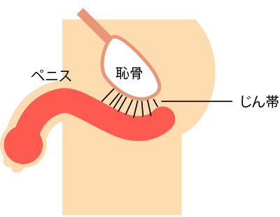 カントン包茎（嵌頓包茎）とは？手術と費用について｜MSクリニック