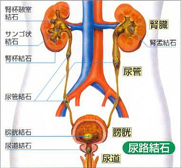 前立腺肥大症 | ～笑顔でスッキリ～ おしっこ