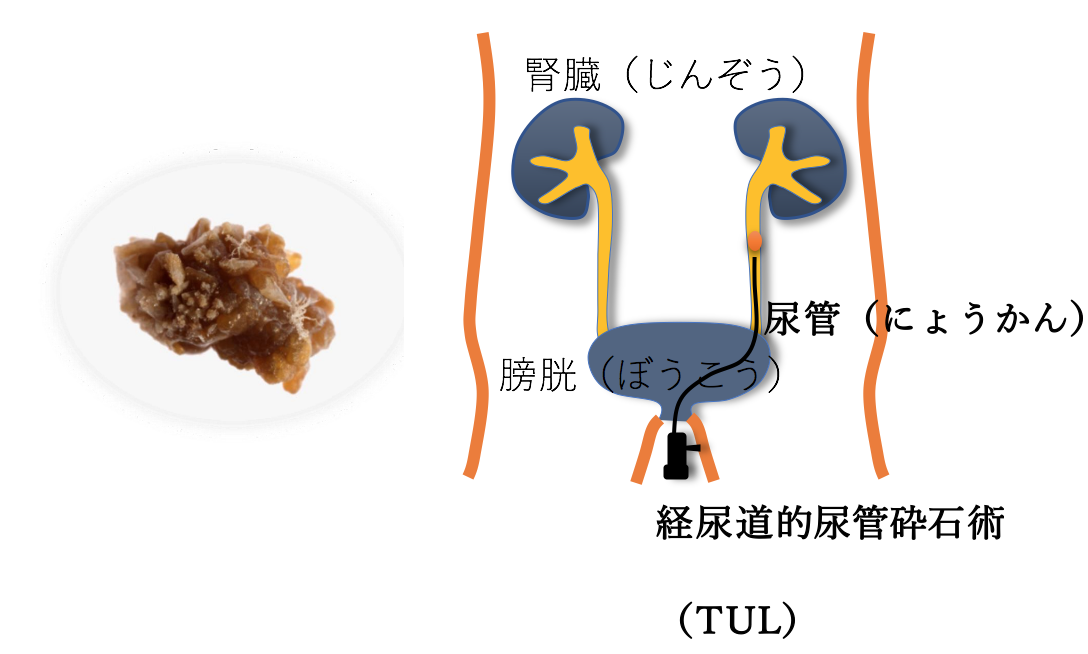 ５分でわかる尿路結石｜激痛が起きる前に検査|まえばる泌尿器科