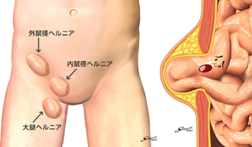 鼠径ヘルニア外来｜聖マリアンナ医科大学病院