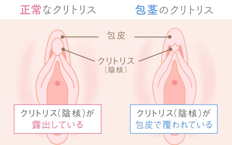 クリトリスがでかいのはどのサイズから？男性目線での魅力も紹介｜風じゃマガジン