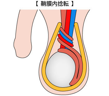 精巣捻転（睾丸捻転）｜すこやかコラム｜ときわ会グループ