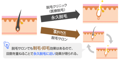 リンクスのメンズ脱毛の口コミ・評判を徹底調査！メリット・デメリットや料金・施術の流れも解説