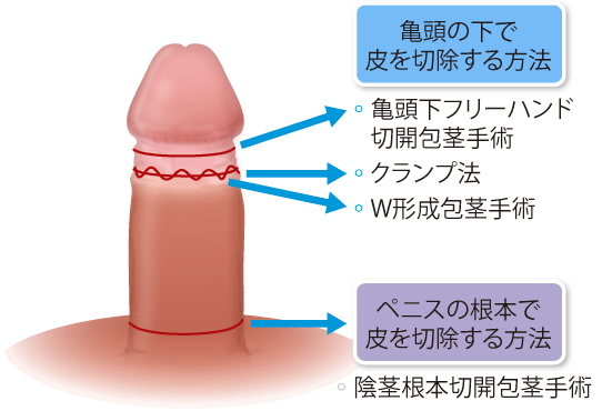 仮性包茎矯正 勃起不全 早漏改善