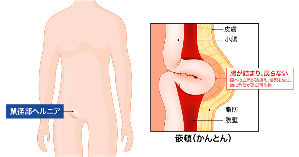 消化器外科 おなかのヘルニアセンター｜診療科・部門のご案内｜近畿大学奈良病院