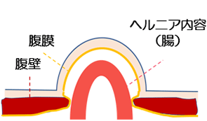 そけい部ヘルニアの日帰り手術。身体に負担の少ない、ヒトツキズ腹腔鏡 | 滋賀大津そけいヘルニア外科クリニック