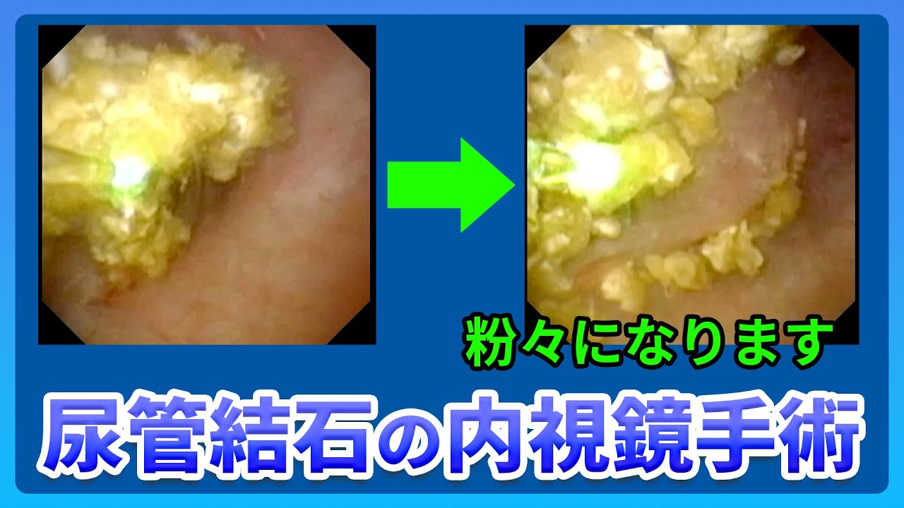 前立腺結石｜神戸市東灘区 摂津本山｜いしむら腎泌尿器科クリニック