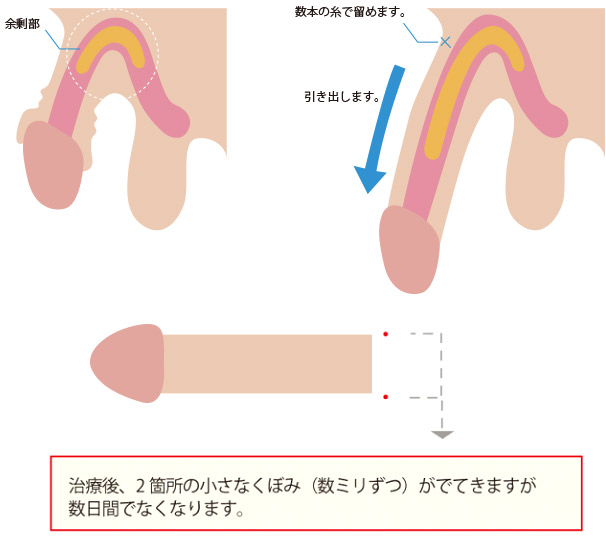 マイクロペニスとは：小陰茎症の原因と治療方法 – メンズ形成外科 | 青山セレス&船橋中央クリニック