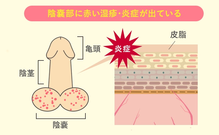 陰嚢の被角血管腫（陰嚢表面の赤いブツブツ） | 診療案内 | 共立美容外科宇都宮院