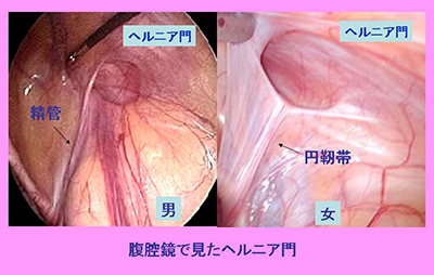 鼠径ヘルニアについて ｜那覇市の内視鏡外科・消化器内科、肛門外科｜友寄クリニック｜胃カメラ・大腸検査