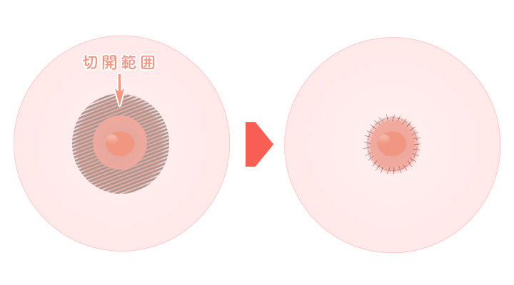 乳輪縮小術 | アールビューティークリニック 俺の 銀座｜男性の美容整形・美容外科・美容皮膚科