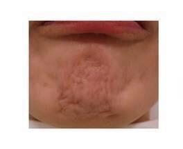 顎の梅干しを唇体操で治してみよう 小顔矯正院発- 小顔矯正・整体を東京でお探しならRevision